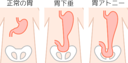 胃下垂 太らない理由